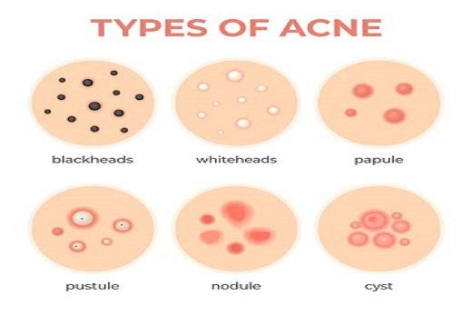 acne treatment , khobsurti store pakistan